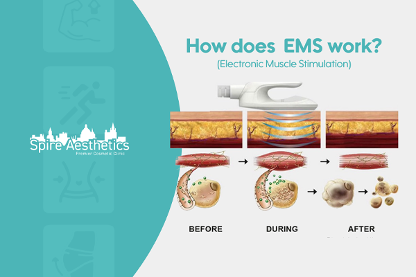 EMS treatment for post pregnancy weight loss treatment Handsworth Wood