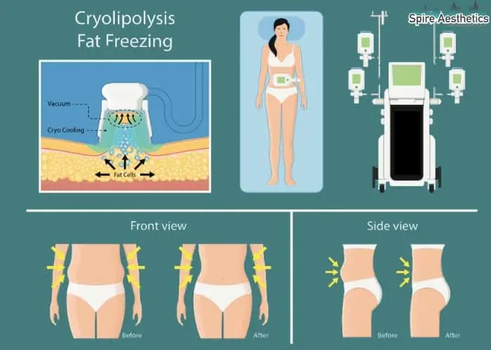 Fat freezing treatment Handsworth Wood benefits for competitions to remove stubborn fat deposits.