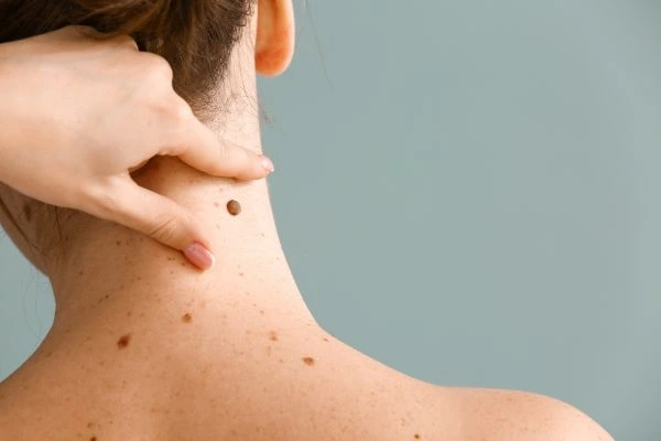 skin blemish removal Handsworth Wood treatment